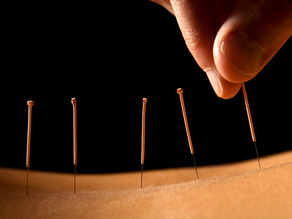 closeup of acupuncture treatment