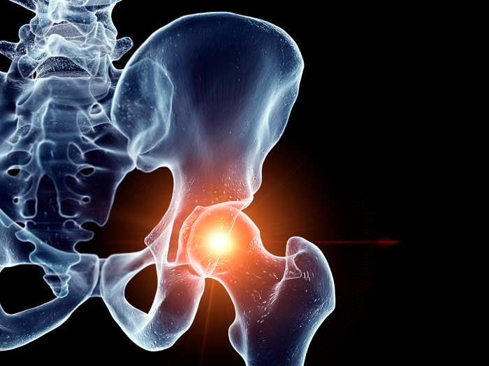 recovery after hip fracture